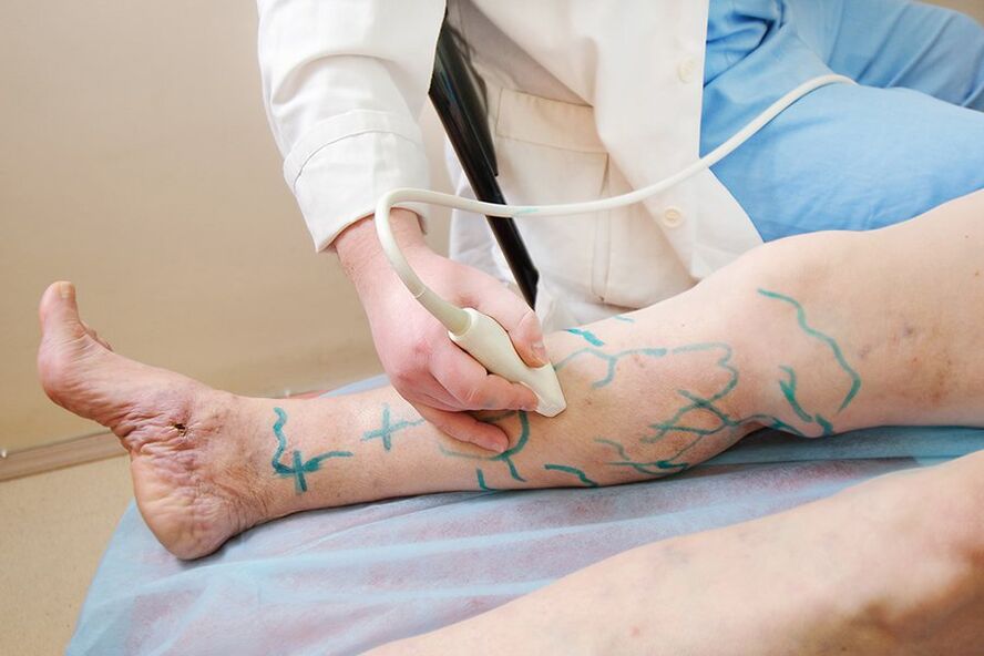 Preparazione per miniflebectomia marcatura sui perforatori della parte inferiore della gamba, esecuzione dell'ecografia